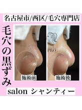 サロン シャンティー/毛穴エクストラクションプロ