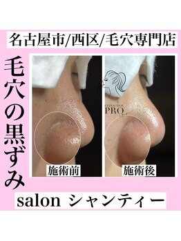 サロン シャンティー/毛穴エクストラクションプロ