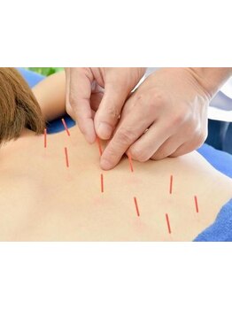 鍼灸施術を受けたい