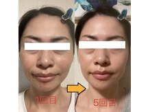 エムズ ラボ(M's Labo)の雰囲気（どんどん小顔に♪たるみ・小ジワ改善にも！ダウンタイムもなし！）