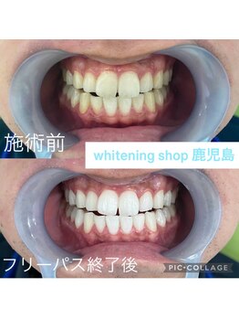 ホワイトニングショップ 鹿児島店/#鹿児島ホワイトニング