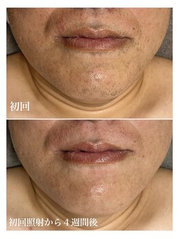 ルシャトン(Le Chaton)/ヒゲ脱毛