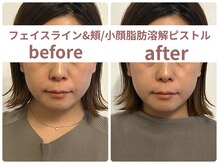 サボラミ(sabor A Mi)/フェイスライン/ピストル施術