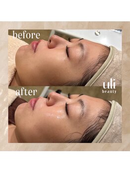 ウリ(uli beauty)/比較写真