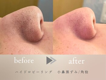 グロッシー(glossy)/【症例】小鼻皮脂詰まり黒ずみ