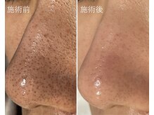 ローズドゥシャロン(Rose de CHALON)/黒ずみ毛穴・角栓・乾燥改善