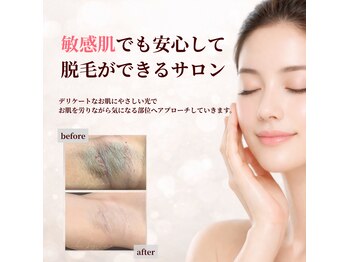 ミーラブ 鹿児島(miilove)の写真/新年度は脱毛デビューにピッタリ♪季節の変わり目でゆらぎやすい敏感なお肌でも安心して綺麗になれるサロン