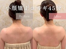 ドレッサー 福岡香椎店(DRESSER)/【症例】小顔コルギ1回の結果