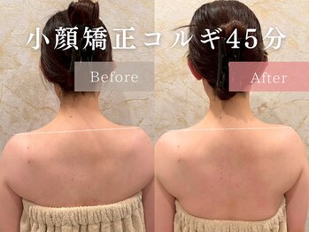 ドレッサー 福岡香椎店(DRESSER)/【症例】小顔コルギ1回の結果