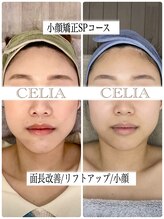 セリア(CELIA)/小顔矯正SPコース