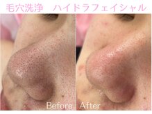 Cスキンケアクリニック 麻布店/毛穴洗浄ハイドラフェイシャル