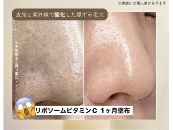 ビューティーサロン リリー(Lily)/毛穴ケア