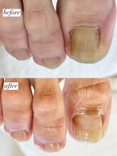 ニコワイズネイル(Nico Y's Nail)/【巻き爪緩和コース】