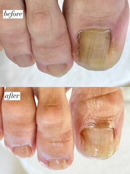 ニコワイズネイル(Nico Y's Nail)/【巻き爪緩和コース】