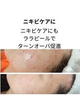 リムビューティー 自由が丘(RymBeauty)/ニキビケアに