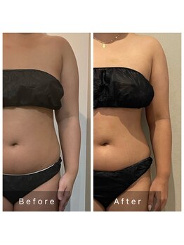 サロン ルイス アディクト(salon Lewis Addict)/【脂肪冷却】熱い痛い施術は古い