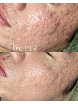 イベリス(Iberis)/ハーブピーリング/ニキビケア
