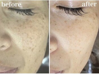 ホワイトアクア 浜松店(WHITE AQUA)/ララピール/ニキビケア