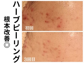 エリン(ERIN)/ハーブピーリング