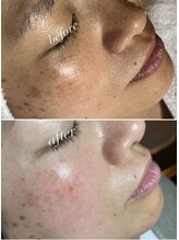 スパークル/シミケア/フェイシャル/美白