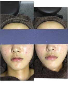 ビー 銀座一丁目駅店(Bee)/乳酸菌ピーリング