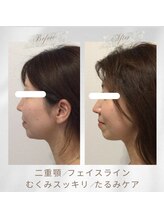 りもあず(ReMore-S)/二重顎、あごのたるみが気になる