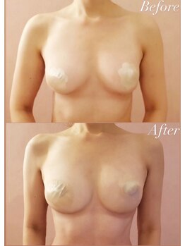 ルミエール(Lumiere)/【倉敷市】バストアップ施術事例