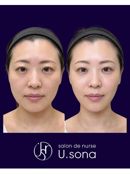 小顔・脂肪コントロール専門 salon de nurse U.sona～松本店～/【顔造形】30代脂肪分解症例