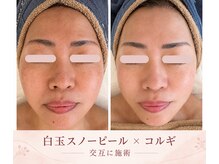 フローラの雰囲気（肌質改善白玉スノーピールで眉間、鼻の毛穴もスッキリ#毛穴洗浄）