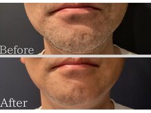 セレ(Cele)/ヒゲ脱毛　効果重視！