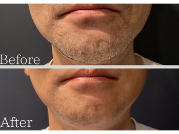 セレ(Cele)/ヒゲ脱毛 効果重視!