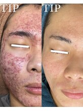 エムエルフ(emuerufu)/※簡単にすぐには変化はしません