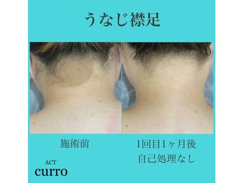 アクト クロ(ACT curro)/【うなじ襟足】脱毛施術例