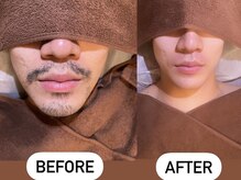 ソーレエルーナ(SOLE e LUNA)/光脱毛 wax脱毛 メンズ