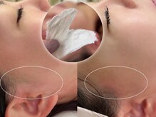 モナ(MoNa)/お顔パーツWAX脱毛