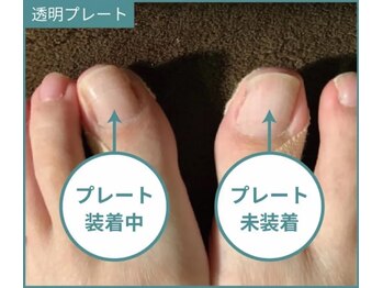 巻き爪研究所 表参道院/矯正中のストレスフリー