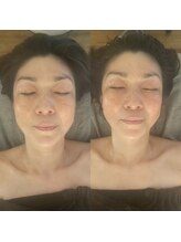 頭庵(zuan)/日本初上陸！頬骨カッター 小顔