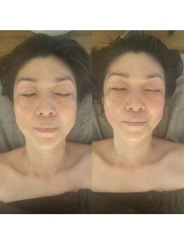 頭庵(zuan)/日本初上陸！頬骨カッター 小顔