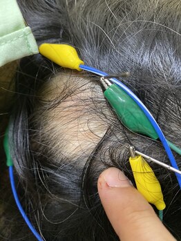 ジェネ鍼灸院/禿も対応します