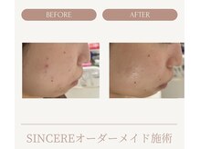 シンシア(SINCERE)/オーダーメイド肌改善プログラム