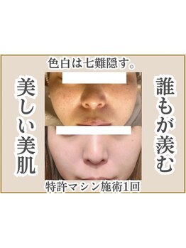 美白ケアをしたい