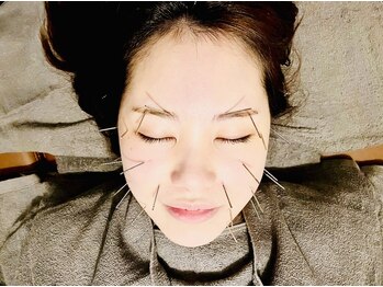 あくび 西麻布(aqu美)の写真/リフトアップ/小顔/肌改善/眼精疲労/噛み締めに◎鍼が苦手な方はお灸や手技で対応。施術後の変化に感動♪