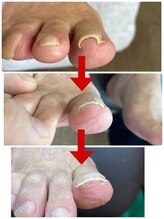 一宮巻き爪センター/巻き爪