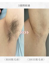 エール(AEELE)/■わき脱毛■