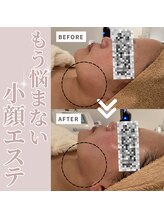 リリアン(RelieN)/リバウンドしない小顔術/リフト