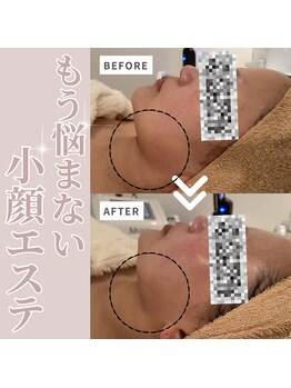 リリアン(RelieN)/リバウンドしない小顔術/リフト