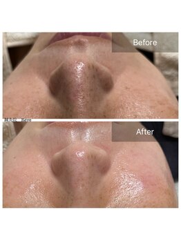 わきさか鍼灸整骨院・鍼灸院 レーヴ(Reve)/スペシャルコースでつやピカ♪