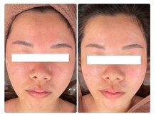 ホワイトアクア つくば店(WHITE AQUA)/ハーブピーリング/毛穴ケア/茨城