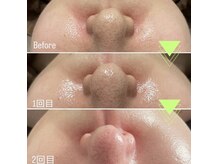 タミの雰囲気（ラミネーションピール&毛穴洗浄）