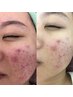 【学割U24】 【ニキビケア集中・毛穴も】少し剥離ありのハーブピーリング